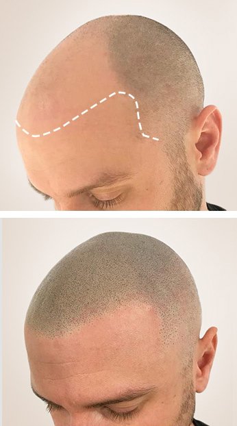 Hairline Restoration